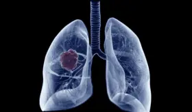 Preocupación ante el aumento los casos de cáncer de pulmón en personas no fumadoras