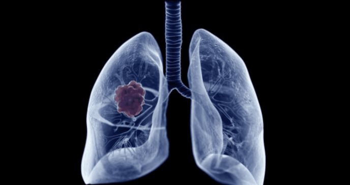 Preocupación ante el aumento los casos de cáncer de pulmón en personas no fumadoras