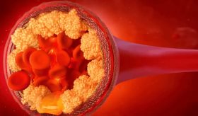 El colesterol elevado podría acelerar el deterioro cognitivo y aumentar el riesgo cardiovascular