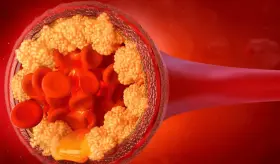 El colesterol elevado podría acelerar el deterioro cognitivo y aumentar el riesgo cardiovascular