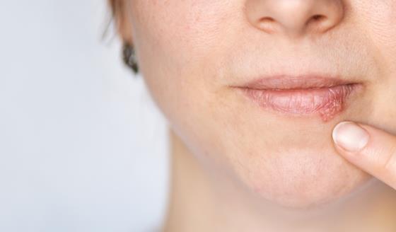 Progreso en el Desarrollo de una Vacuna contra el Herpes