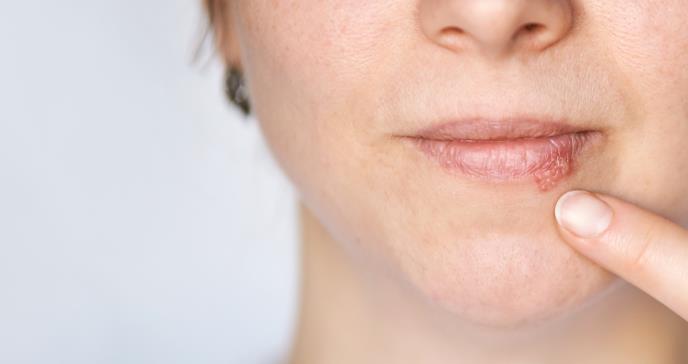 Progreso en el Desarrollo de una Vacuna contra el Herpes