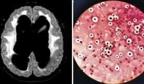 Convulsiones, coma y daño neurológico severo como consecuencias de la meningitis fúngica