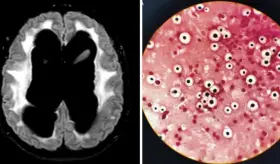 Convulsiones, coma y daño neurológico severo como consecuencias de la meningitis fúngica