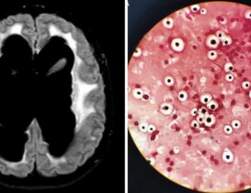 Convulsiones, coma y daño neurológico severo como consecuencias de la meningitis fúngica