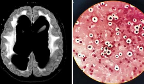 Convulsiones, coma y daño neurológico severo como consecuencias de la meningitis fúngica