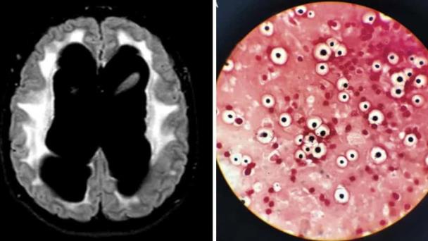Convulsiones, coma y daño neurológico severo como consecuencias de la meningitis fúngica