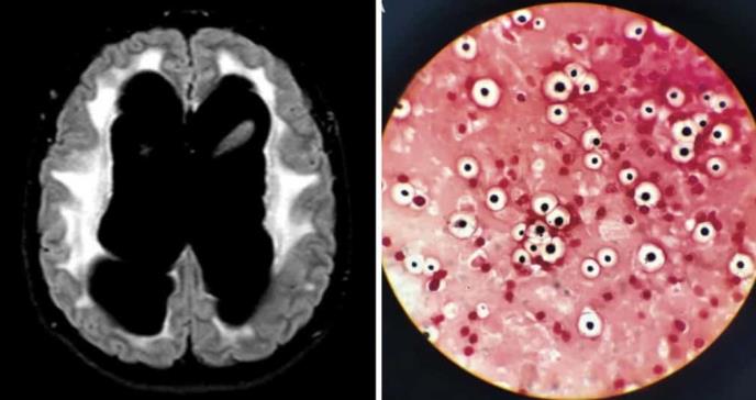 Convulsiones, coma y daño neurológico severo como consecuencias de la meningitis fúngica