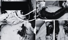 Presentación atípica de necrólisis epidérmica tóxica en menor de 6 meses sin lesiones cutáneas visibles