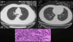 Consumo de Moxifloxacino ocasiona neumonitis, fiebre y dificultad para respirar en paciente de 45 años