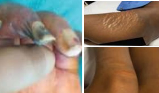 Niña de 9 años con artritis idiopática juvenil de inicio sistémico desarrolló grave gangrena periférica