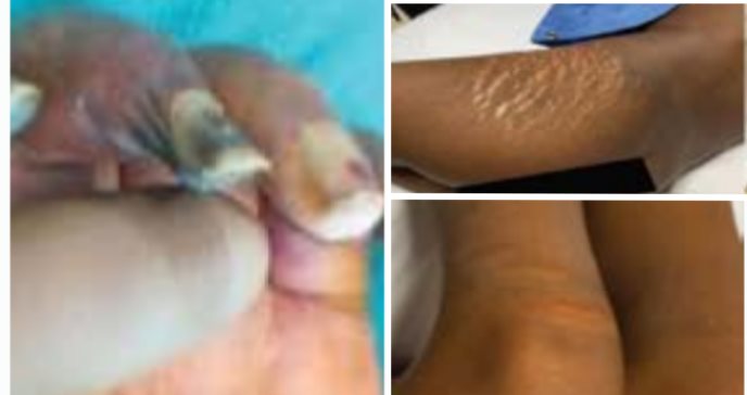 Niña de 9 años con artritis idiopática juvenil de inicio sistémico desarrolló grave gangrena periférica