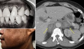 Joven presenta síncope, encías oscuras, fatiga y mareo asociado con insuficiencia suprarrenal