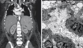 Disminución de los genes TMSB4X-EEF1A1 se relacionaría con nefropatía lúpica y desregulación inmunológica