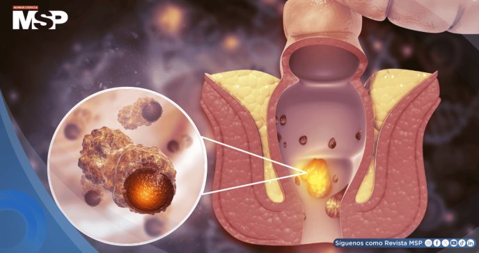 FDA aprueba nueva terapia de Retifanlimab-dlwr en primera línea para cáncer anal escamoso avanzado