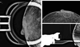 Paciente presenta cáncer de mama con distintos tipos de tumor y características moleculares diferentes