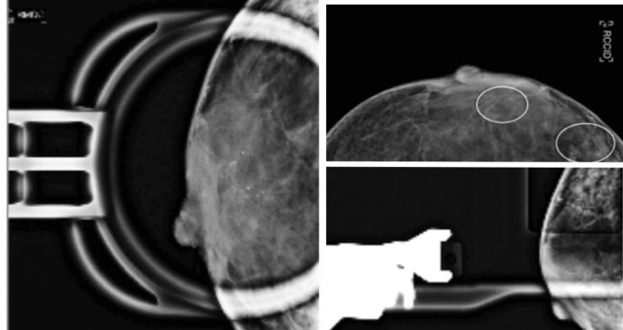 Paciente presenta cáncer de mama con distintos tipos de tumor y características moleculares diferentes