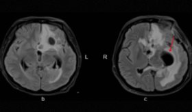 Mujer de 24 años con coma postcesárea presenta abscesos cerebrales por bacterias orales