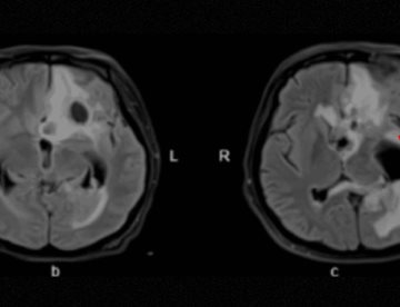 Mujer de 24 años con coma postcesárea presenta abscesos cerebrales por bacterias orales