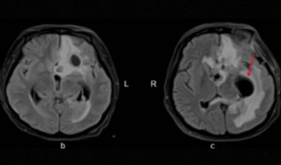 Mujer de 24 años con coma postcesárea presenta abscesos cerebrales por bacterias orales