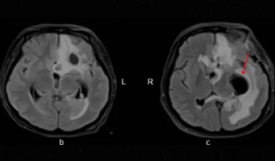 Mujer de 24 años con coma postcesárea presenta abscesos cerebrales por bacterias orales