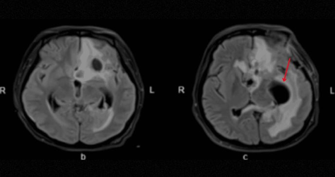 Mujer de 24 años con coma postcesárea presenta abscesos cerebrales por bacterias orales