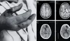 Paciente presentó reactivación de toxoplasmosis cerebral 8 años después de trasplante renal