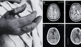 Paciente presentó reactivación de toxoplasmosis cerebral 8 años después de trasplante renal