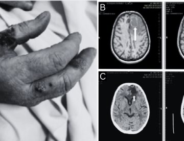 Paciente presentó reactivación de toxoplasmosis cerebral 8 años después de trasplante renal