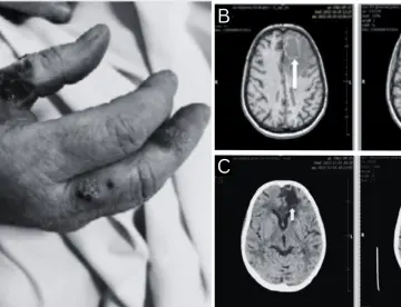 Paciente presentó reactivación de toxoplasmosis cerebral 8 años después de trasplante renal