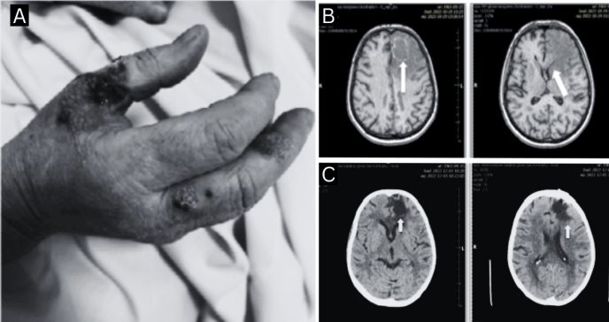 Paciente presentó reactivación de toxoplasmosis cerebral 8 años después de trasplante renal
