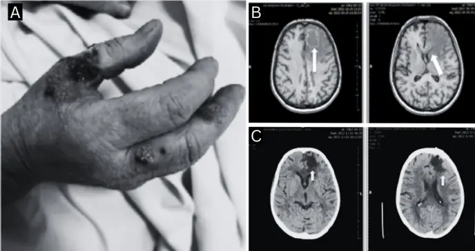 Paciente presentó reactivación de toxoplasmosis cerebral 8 años después de trasplante renal