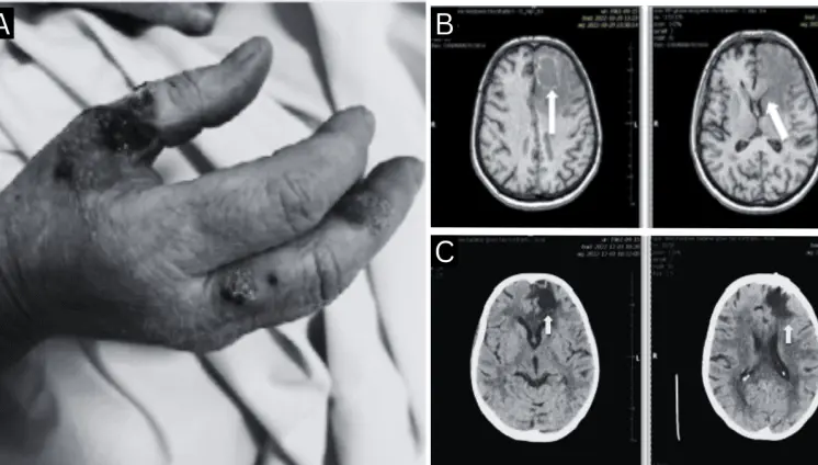 Paciente presentó reactivación de toxoplasmosis cerebral 8 años después de trasplante renal