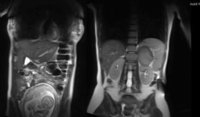 Síndrome de Cushing en gestante diabética es tratado con adrenalectomía en la semana 32