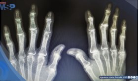 Desigualdad de acceso económico a servicios médicos en artritis reumatoide por género y seguro: estudio