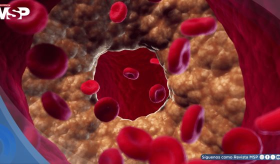 Alta prevalencia de dislipidemia en pacientes con diabetes tipo 2 en Puerto Rico, según estudio 