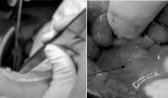 Apendicitis complicada con absceso y ruptura de quiste ovárico en mujer con taquicardia y anorexia 