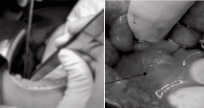 Apendicitis complicada con absceso y ruptura de quiste ovárico en mujer con taquicardia y anorexia 