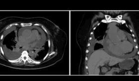 Paciente inmunocompetente presenta linfoma cardíaco con extensión mediastinal y compromiso sistémico