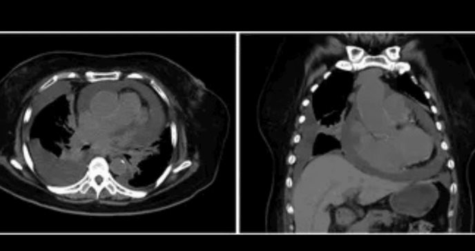 Paciente inmunocompetente presenta linfoma cardíaco con extensión mediastinal y compromiso sistémico
