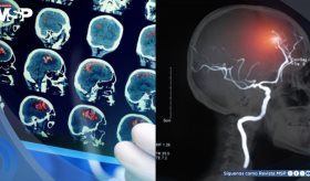 El impacto de los disturbios emocionales en la rehabilitación de sobrevivientes de ACV en Puerto Rico  