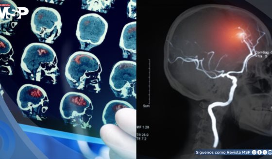 El impacto de los disturbios emocionales en la rehabilitación de sobrevivientes de ACV en Puerto Rico  
