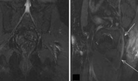 Neuropatía del nervio ciático secundaria a úlcera sacral por presión en paciente post-COVID-19  