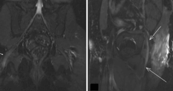 Neuropatía del nervio ciático secundaria a úlcera sacral por presión en paciente post-COVID-19  