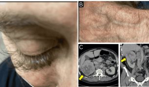 Crecimiento anormal de pestañas como señal inicial de un carcinoma renal metastásico