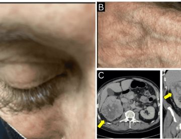 Crecimiento anormal de pestañas como señal inicial de un carcinoma renal metastásico