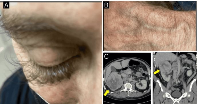 Crecimiento anormal de pestañas como señal inicial de un carcinoma renal metastásico