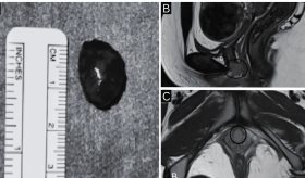 Leiomioma uretral primario hallado incidentalmente durante la higiene personal en mujer de 33 años