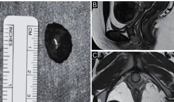 Leiomioma uretral primario hallado incidentalmente durante la higiene personal en mujer de 33 años