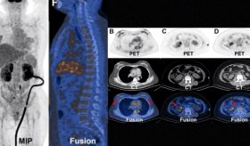 Descubren metástasis renal atípica por cáncer de mama bilateral en mujer de 49 años anémica 